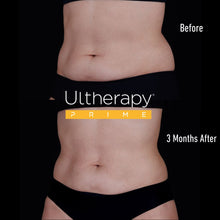 Load image into Gallery viewer, Ultherapy PRIME® Abdomen