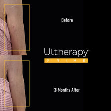 Load image into Gallery viewer, Ultherapy PRIME® Arms

