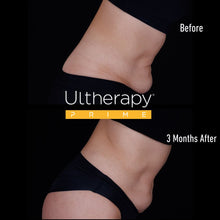 Load image into Gallery viewer, Ultherapy PRIME® Abdomen
